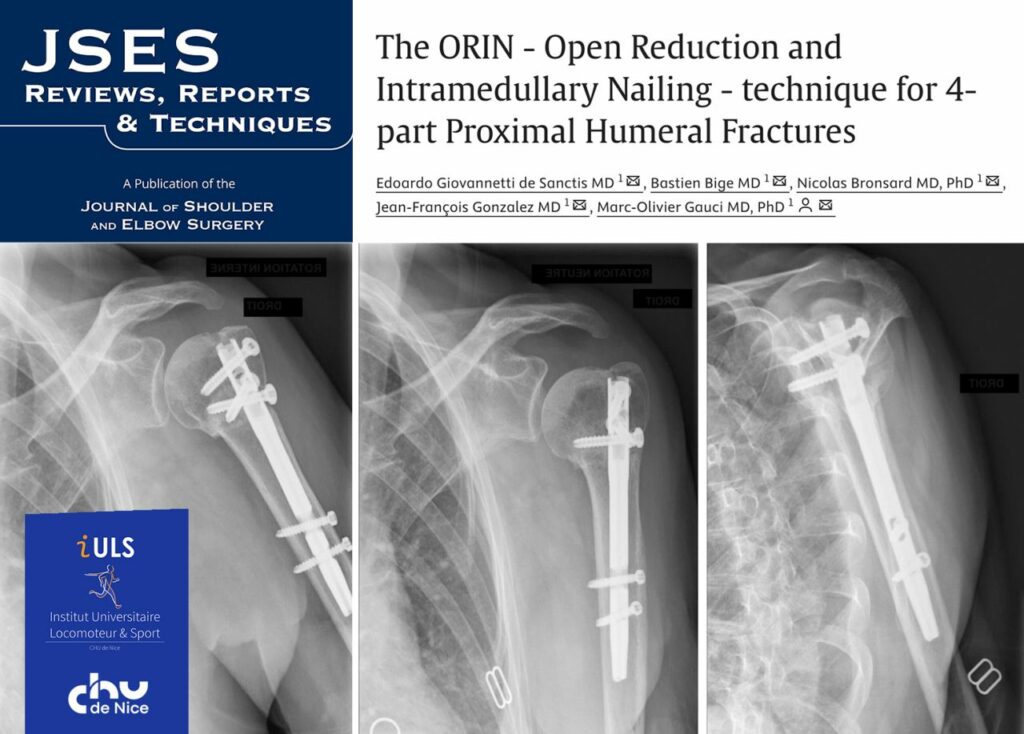 Nouvelle publication pour l’équipe de l’Institut Universitaire Locomoteur et du Sport du CHU de Nice !